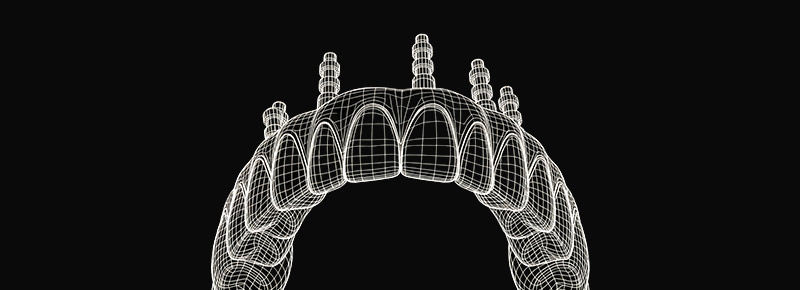 Dental implant wireframe
